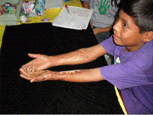 Picture4-300×225 a showing his both hand on a table his hand are burned